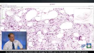 Pathology Insights  Soft Tissue Pathology with John Goldblum MD [upl. by Casey]