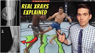 Chris Weidman Shares REAL Xrays of Broken Leg from UFC 261  Doctor Explains Images [upl. by Luanni]