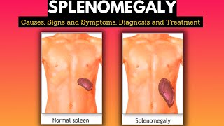 Splenomegaly Causes Signs and Symptoms Diagnosis and Treatment [upl. by Bamford]