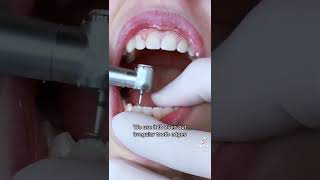 Enameloplasty  Filing Edges of Your Teeth w TheBracesDoc [upl. by Granniah]