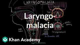 Laryngomalacia  Respiratory system diseases  NCLEXRN  Khan Academy [upl. by Tecil970]