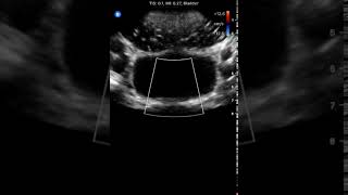 Bladder Ureteric Jets Butterfly iQ Clinical Image [upl. by Kirsti]