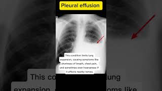 Pleural Effusion explained [upl. by Llyrad]