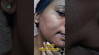 Day19 Using Tretinoin 0025 cream viralvideo tretinoin youtubeshorts skincare shorts [upl. by Stringer]