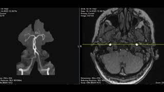 Basilar artery fenestration [upl. by Enivid]