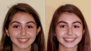 Braces Before and After with Reshaping of Front Teeth [upl. by Atterrol]