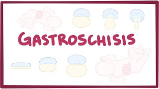 Gastroschisis  causes symptoms diagnosis treatment pathology [upl. by Hewett307]