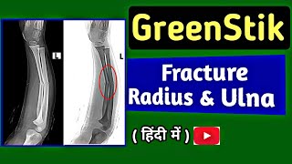 GreenStick Fracture of Radius amp Ulna  GreenStick Fracture in Children  XRay ForeArm  UdayXray [upl. by Cirala]