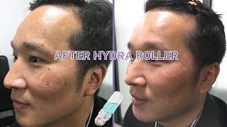 How to use hydra roller 64 needles at home Microneedling at home mesotherapy microneedling [upl. by Presley]