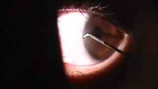 Corneal Foreign Body [upl. by Nickerson]