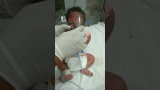 pneumonia baby nebulizer and physiotherapy baby doctor nursing nice shorts shortsvideo viral [upl. by Iover]