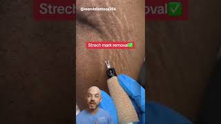 Does this count as a stretch mark removal⁉️ credit marvinstattoos256 on TT doctor satisfying [upl. by Namlaz]