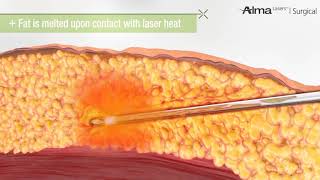 Laser Liposuction [upl. by Hazeefah]