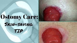 Ostomy care Healing the Skin around the Stoma [upl. by Hermes]