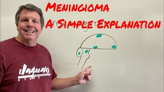 Meningioma A Simple Explanation [upl. by Anwahsiek]