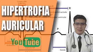 HIPERTROFIA DILATACIÓN Y CRECIMIENTOS DE LAS AURÍCULAS CARDÍACAS EKG [upl. by Nihs]