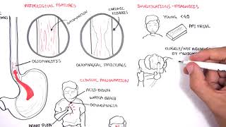 GORD GERD Gastro Oesophageal Reflux Disease  Overview pathophysiology treatment [upl. by Atnuahc678]