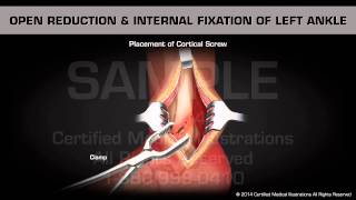 Open Reduction amp Internal Fixation of Left Ankle [upl. by Anibas]