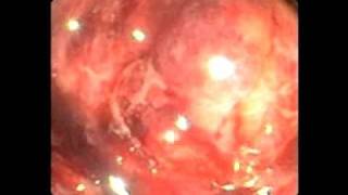 Endoscopy Master Videos ERCP metal stent in a metal stent  wwwgastrolivercomsg [upl. by Nylsirk]