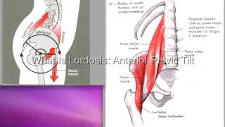 What is Lordosis Anterior Pelvic Tilt [upl. by Micah]