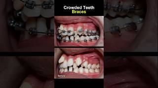 Teeth very crowded and crooked before braces orthodontist braces dentist [upl. by Keung]