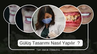 Gülüş Tasarımı Aşamaları Nelerdir  Nasıl Yapılır  Ne Kadar Zaman Gerekir  Dt Elnaz YILDIZ [upl. by Zendah]