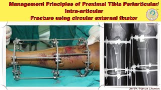 Proximal Tibia PeriarticularIntraarticular Fracture using circular external fixator [upl. by Fihsak]