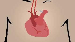 Embolic Stroke [upl. by Lamson]