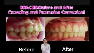 BracesBefore and After Crownding and Protrusion Correction [upl. by Felisha423]