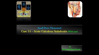 Ultrasound Case 14  Acute Calculous Sialadenitis Web case [upl. by Inahpets242]