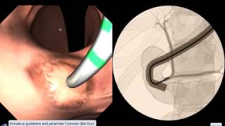 EndoSim Endoscopic Retrograde Cholangiopancreatography  ERCP [upl. by Anjali]