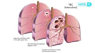Verem Tüberküloz Nasıl Tedavi Edilir [upl. by Wait]