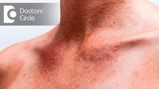 How to avoid and treat Summer Rashes and Stings  Dr Rajdeep Mysore [upl. by Leblanc]