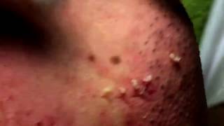 Acne Solution  Blackheads amp Whiteheads Removal 1  How to get rid of acne [upl. by Minabe]