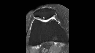 Chondromalacia patella [upl. by Tory]