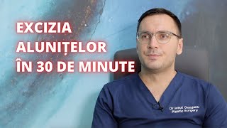 Excizia alunitei în 30 de minute  DermaBeauty Clinique [upl. by Avaria]