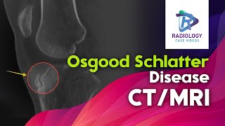 Osgood Schlatter disease CT and MRI Anterior Knee PainTibial Tubercle Avulsion [upl. by Maharva]