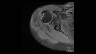 How nondisplaced GT fracture of humerus improve in 1 year [upl. by Nwahsar]