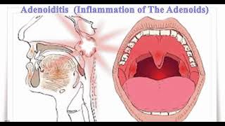 ADENOIDITIS Definition of adenoiditis Causes of adenoiditis Symptoms of adenoiditis✨ [upl. by Temirf]