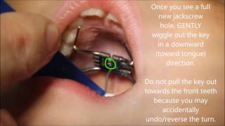 How To Turn a Rapid Palatal Expander [upl. by Nnaynaffit]