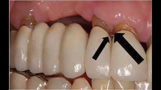 The Difference Between a Dental bridge and Dental implant [upl. by Eustatius964]