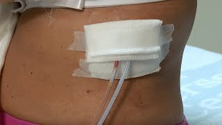 How to care for a postsurgery wound drainage system and gauze dressing [upl. by Genny593]