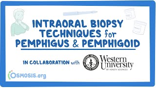 Intraoral Biopsy Techniques for Pemphigus amp Pemphigoid in Collaboration w Western University [upl. by Nyvrem]