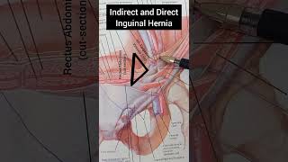 Indirect and Direct inguinal hernia  Anatomy [upl. by Emmett]