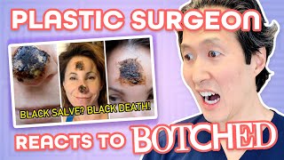 Plastic Surgeon Reacts to BOTCHED DIY Cancer Treatment Destroys Nose [upl. by Wooster]