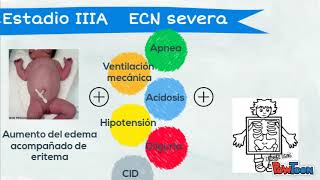 Enterocolitis necrotizante [upl. by Nita]