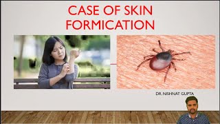 CASE OF SKIN FORMICATION by Dr NISHANT GUPTA [upl. by Arrakat]