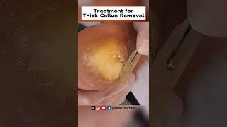 Palmoplantar Keratoderma Relief Expert Treatment for Thick Callus Removal by miss foot fixer [upl. by Eiramanna622]