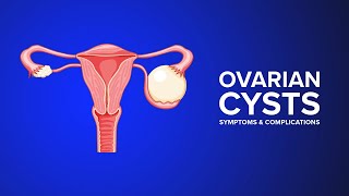 Ovarian Cysts  Symptoms and Complications Explained by an OBGYN [upl. by Colburn]