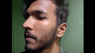 permanent results of minoxidil on beard  man matters beardmax  used for 6 months 🌿 [upl. by Aleahc]